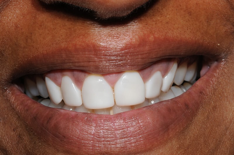 Close up of Cynthia's teeth before dental work, showing crooked and slightly gapped teeth.