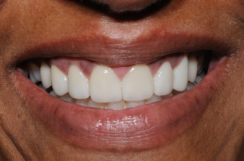 Close up of Cynthia's teeth after getting porcelain veneers from Dr. Mullaney.