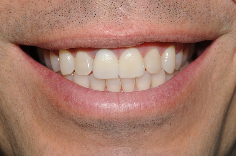 Close up of Dan's smile after Invisalign, whitening and veneers.