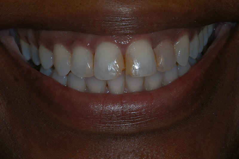 Close up of Aisa's teeth before dental work, showing discolored and cracked front teeth.