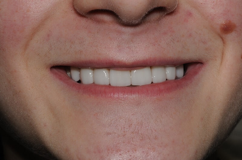 Close up of Eli's teeth after getting a smile makeover with porcelain veneers.
