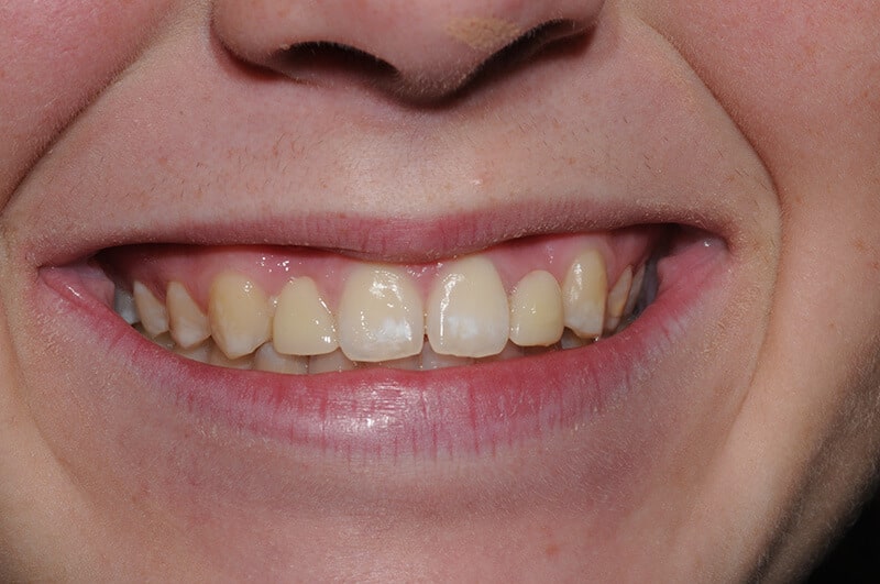 Emma's smile before dental treatment at Dr. Kathleen Mullaney, DDS.