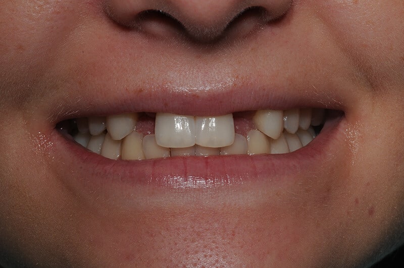 Closeup of Emma's teeth before dental work, showing a few missing teeth.