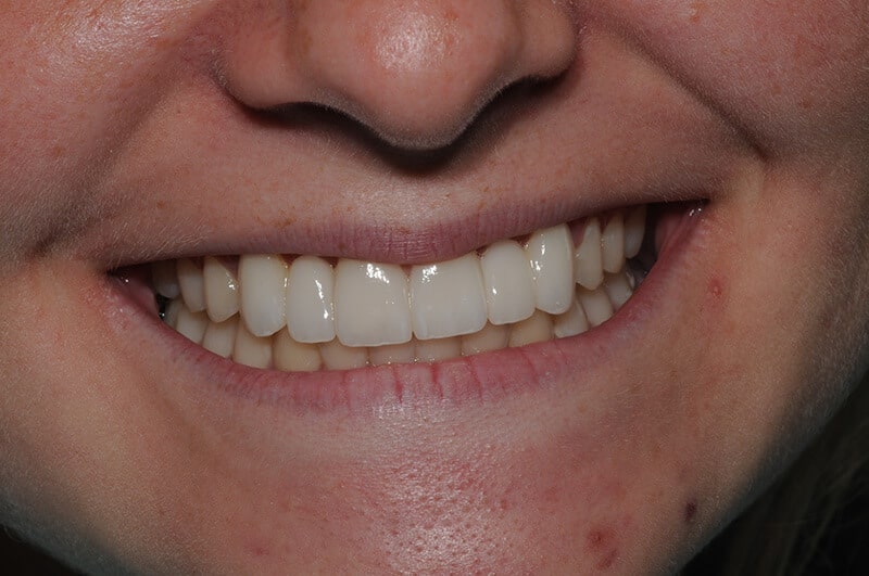 Closeup of Emma's smile after receiving a porcelain bridge and veneers to replace missing teeth.