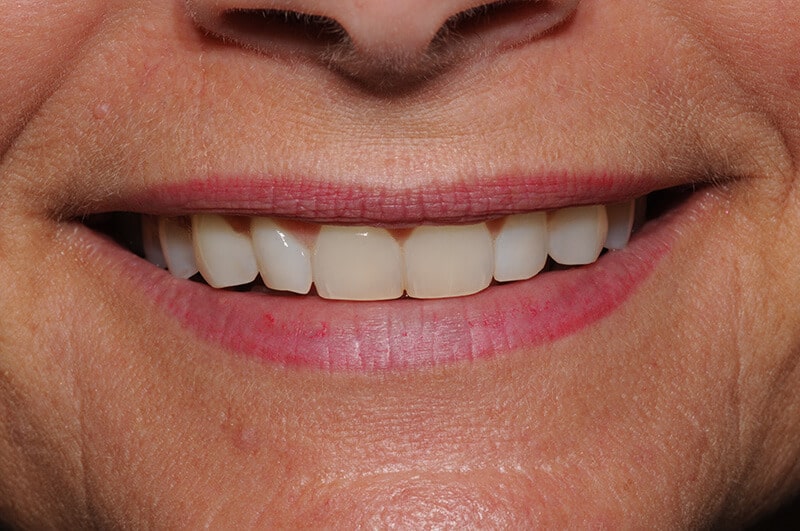 Close up of Karen's teeth before dental work, showing shortened and chipped teeth.