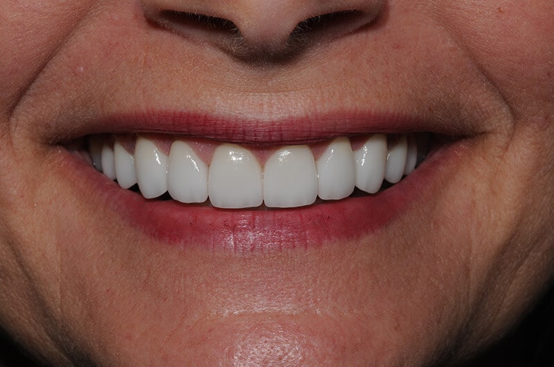 Close up of Karen's smile after getting porcelain veneers from Dr. Mullaney.