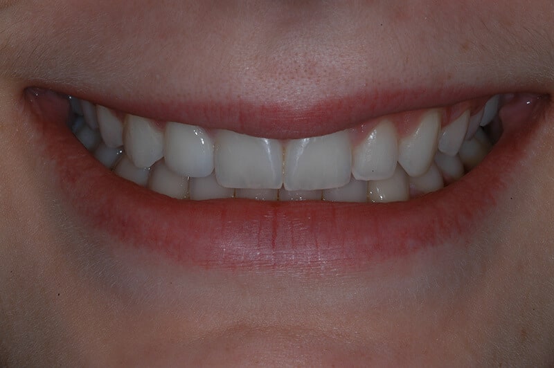 Close up of Kristen's teeth after getting veneers and a whitening treatment from Dr. Mullaney.