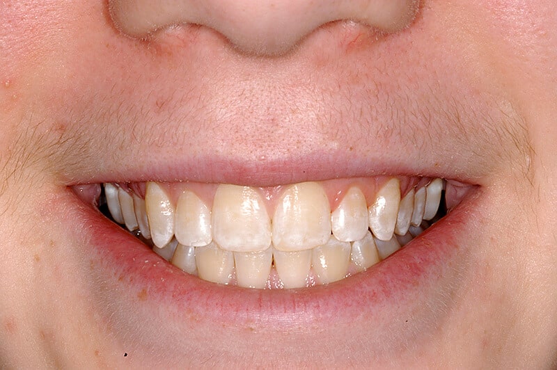 Close up of Matthew's teeth before treatment, showing discolored teeth.
