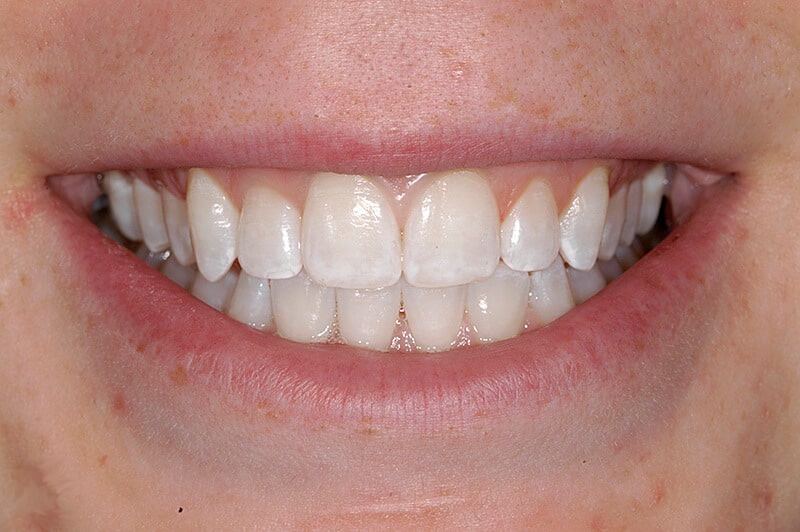 Closeup of Matthew's teeth post-teeth whitening treatment.