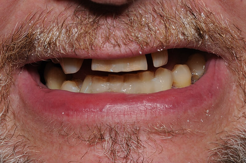 Closeup of Richard's teeth before dental work, which shows missing teeth.