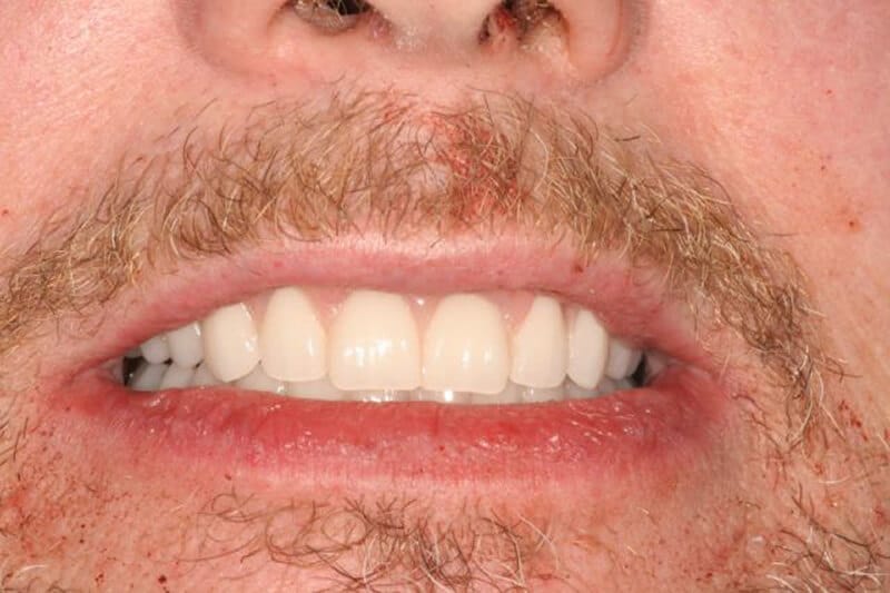 Closeup of Richard's smile post implant treatment.