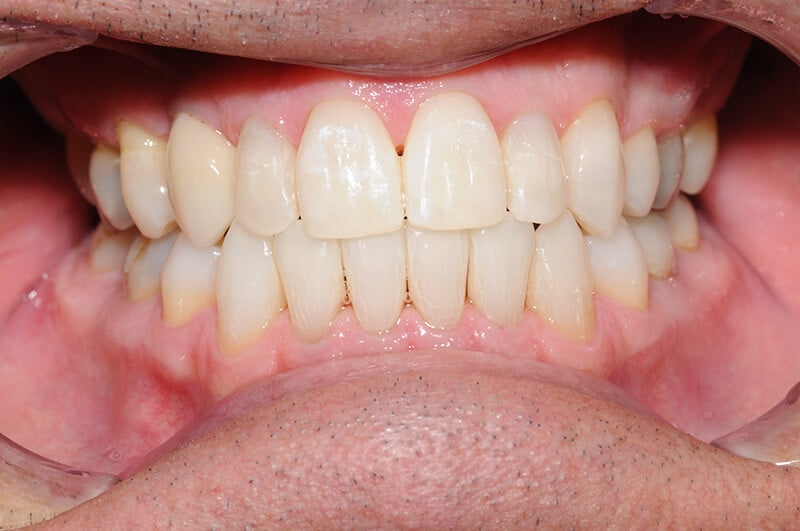 Close up of Tom's smile after dental work, which included implants, Invisalign and whitening.