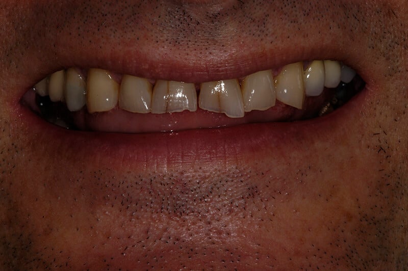 Close up of Tony's teeth before treatment, showing severely chipped and cracked teeth.