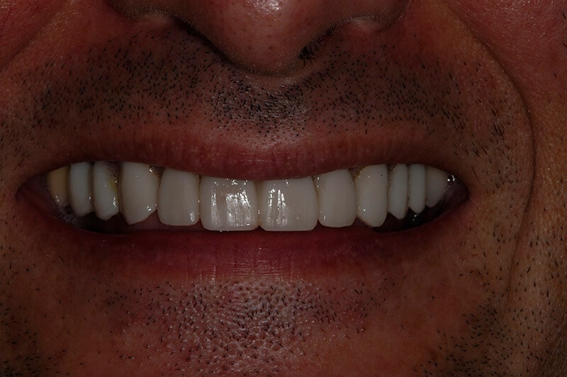 Close up of Tony's straight, white teeth after treatment.