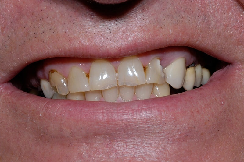 Close up of Wes' smile before dental work, showing plaque buildup on crooked, uneven teeth.