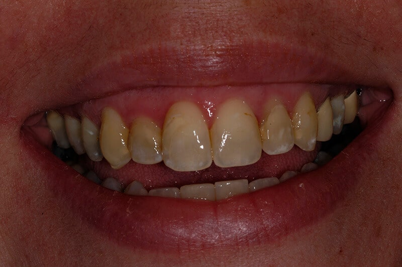 Close up of Ann's teeth before treatment, showing yellowed teeth.