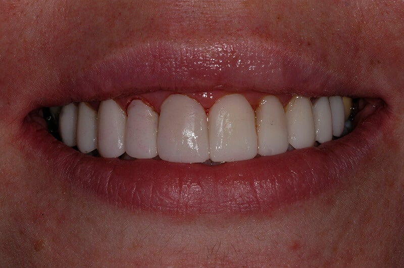 Closeup of Ann after receiving porcelain veneers, showing a straight, white smile.