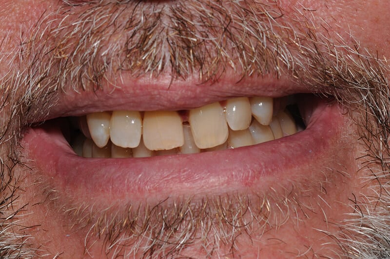 Close up of Chris' teeth before dental work, showing yellowed teeth with gaps between them.