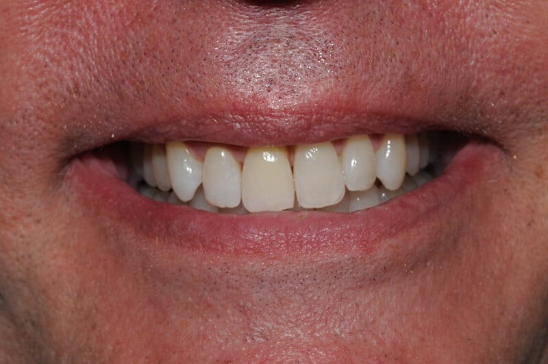Close up of Chris' smile after Invisalign and whitening treatments.
